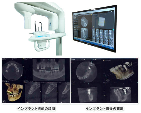 歯科用CT装置の画像　インプラント術前と術後